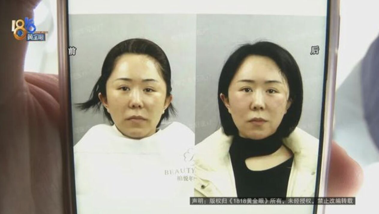 ▲寧波張女士秀出醫美前後比對照，認為沒有效果。（圖／翻攝浙江廣電）