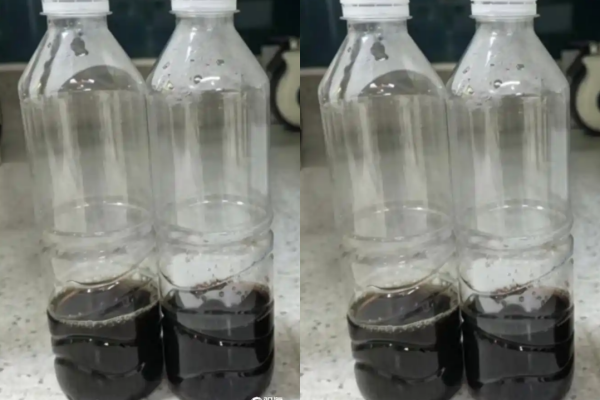 8歲陸男尿液突呈「醬油」色 醫一看指:是「吃紅血球」的怪病