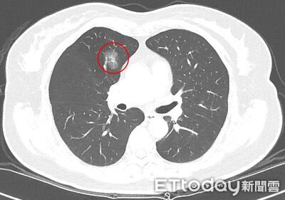 肺癌篩檢揪出結節2/3是惡性　7年僅長大0.2公分手術後才確診