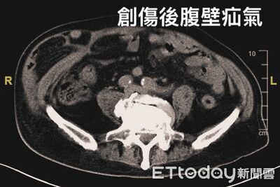 車禍害腹壁破損20公分腸道外露　機器手臂重建3天恢復行走