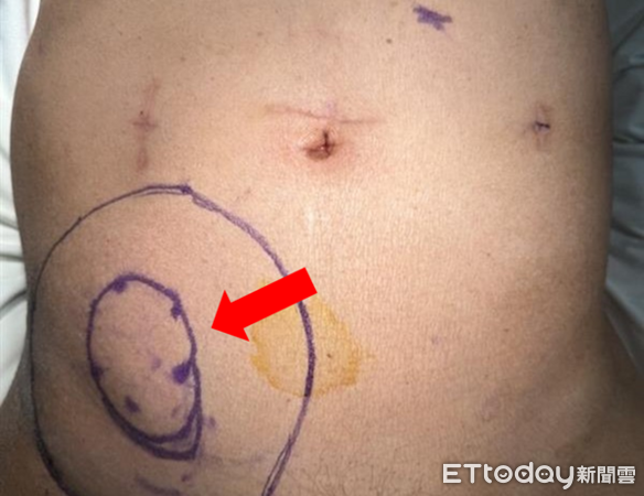 ▲▼        疝氣     。（圖／亞東醫院提供）