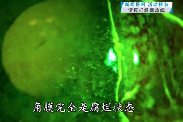 ▲▼男子的眼角膜全腐爛。（圖／翻攝自光明網）