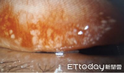 電競國手狂練傷眼　雙眼結石近千顆！連角膜都被磨傷