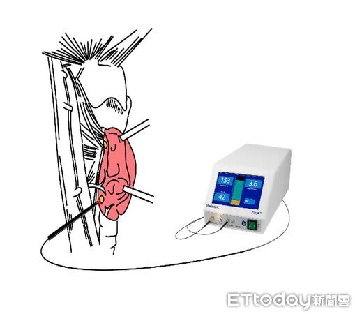 ▲▼       副甲狀腺      。（圖／亞東醫院提供）
