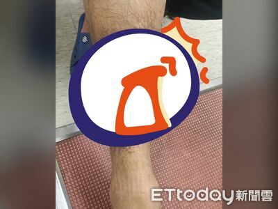 獨／密集恐懼慎入！他狂抓癢冒顆粒　小腿生出「蟾蜍皮」伴10年