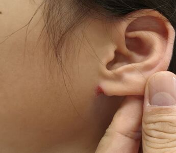 指月亮被割耳？女童「耳垂裂開滲血」嚇壞　醫揭真相：皮膚在說話