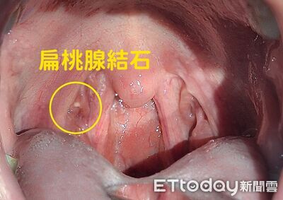 刷牙也沒用！喉嚨藏「黃白小顆粒」臭翻　醫4招斷絕：別用手摳