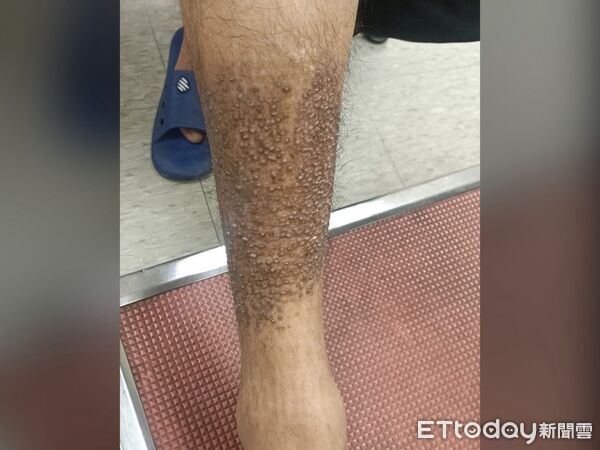 ▲▼密集恐懼慎入！男皮膚癢狂抓冒顆粒　小腿變「蟾蜍皮」伴10年。（圖／黃麗珊醫師提供）