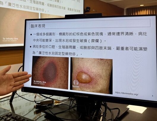 ▲連下體「也爆紅疹水泡」！20歲男吃藥過敏　醫示警4類藥物。（圖／取自成大醫院網站）