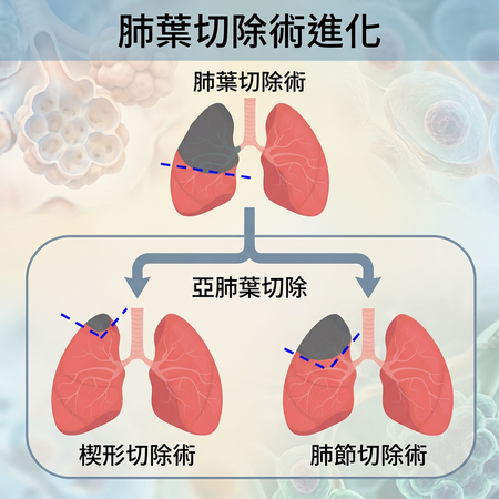 ▲▼       肺葉切除      。（AI協作圖／記者邱俊吉製作，經編輯審核）