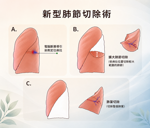 ▲▼     肺節切除        。（AI協作圖／記者邱俊吉製作，經編輯審核）