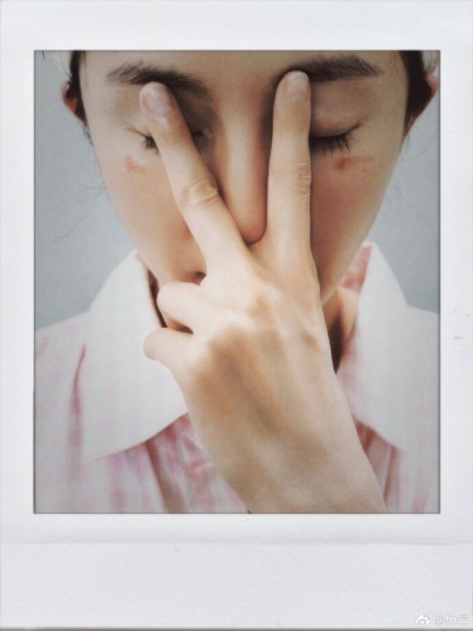 ▲▼楊冪險遭蒸汽眼罩毀容！　傷照曝光…她警告：是低溫燙傷。（圖／翻攝自微博／楊冪）