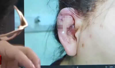 一針面癱！ 上海少女整形「精靈耳」栓塞終身殘疾