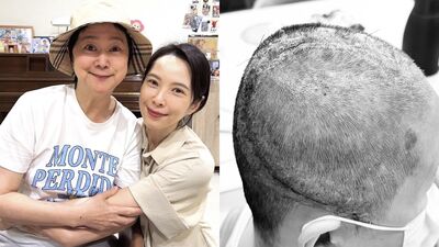 腦部兩側出血急救！王月首曝術後「環狀傷痕」照　深夜開刀4小時