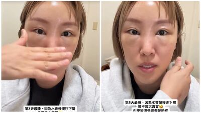這誰？！她困擾41年「終於動手術」  公開超真實腫臉：變漂亮過程