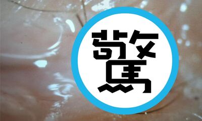 8歲童午睡眼睛劇痛驚醒　驚見巨活螞蟻在眼內「瘋狂啃咬」原因曝