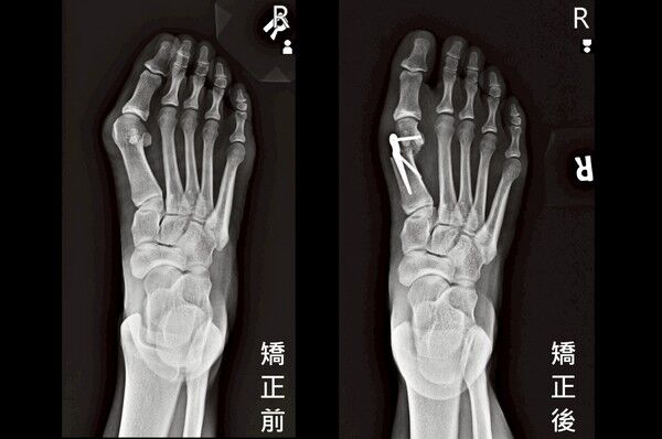 ▲拇趾外翻拖久恐變形，醫示警三徵兆儘早就醫