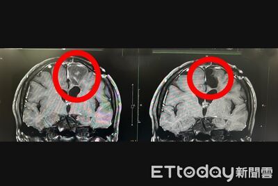 開腦一半被叫醒！男「邊動刀邊測試」　2周康復衝大巨蛋看TWICE