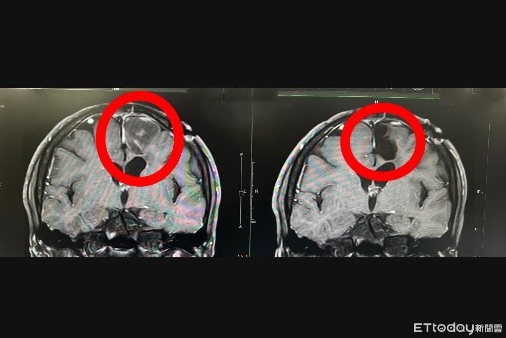 開腦一半被叫醒!男「邊動刀邊測試」 2周康復衝大巨蛋看TWICE