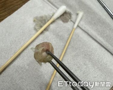 6歲妹鼻塞！醫驚見「圓形鼻涕」吸不動　下秒夾出一整團
