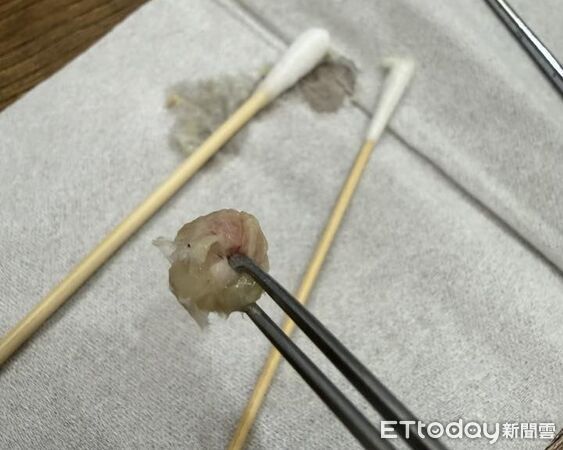 ▲▼6歲妹鼻塞！醫驚見「圓形鼻涕」吸不動　下秒夾出整團爸氣炸。（圖／郭子龍醫師授權提供，未經同意請勿任意翻攝）