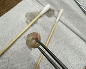 6歲妹鼻塞！醫驚見「圓形鼻涕」吸不動　下秒夾出一整團