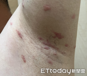 癢到瘋掉！他腋下「遭禽蟎暴咬吸血」　醫驚喊：地獄職災