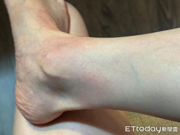 ▲▼一堆人就你最吸蚊？皮膚醫揭「蚊子愛5特質」　雙腳被叮10包苦笑。（圖／林昀萱醫師授權提供，未經同意請勿任意翻攝）