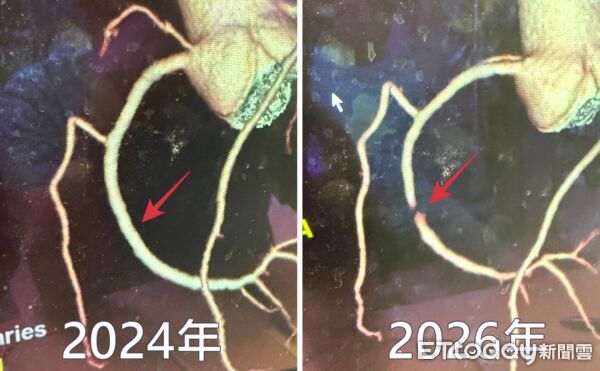 ▲醫師提醒民眾如果有呼吸會喘、胸痛等不舒服前兆，務必儘速就醫，尤其抽菸族更是高危險群。（圖／記者游瓊華翻攝）