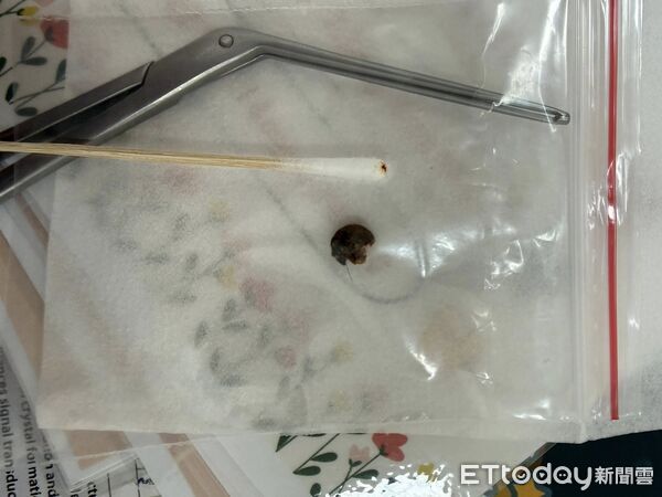 ▲愛用棉花棒！阿伯「封印級黑耳垢」塞10年痛慘　醫苦戰3回。(圖／郭子龍醫師授權提供，未經同意請勿任意翻攝)