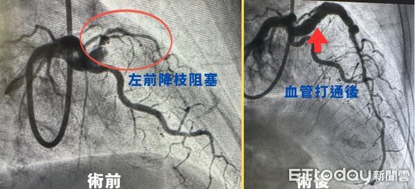 ▲▼   心梗          。（圖／中醫大新竹附醫提供）