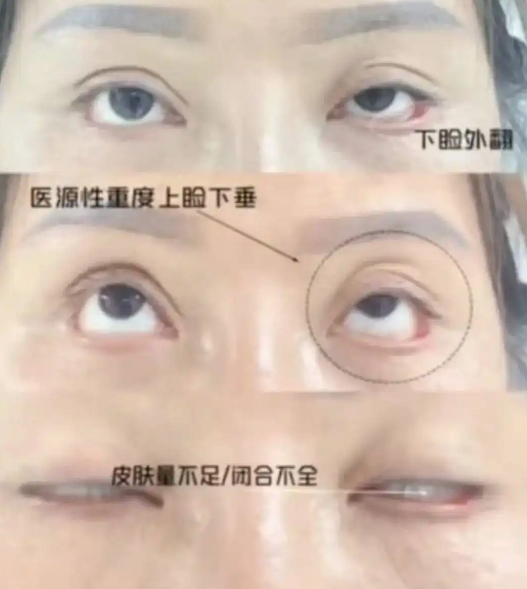 ▲王麗雙眼無法閉合。（圖／翻攝自封面新聞）