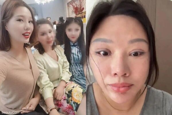 女子割雙眼皮後「無法閉眼還狂流淚」 她崩潰喊:睡覺也睜眼