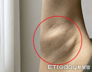 她「腋下凸一大包」拖半年罹乳癌！醫揭6警訊：早期大多不會痛