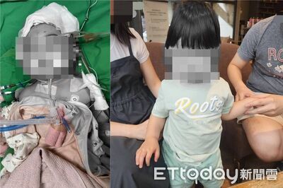 獨／女嬰托育竟腦重創「5度開顱」　保母測謊未過卻獲不起訴