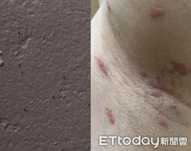 兒全身癢爆！爸翻出「禽蟎大軍爬行片」　醫驚：一家遭集體叮咬