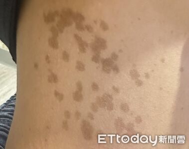 27%兒童都有！女孩冒多處「咖啡牛奶斑」　醫示警：恐藏遺傳疾病