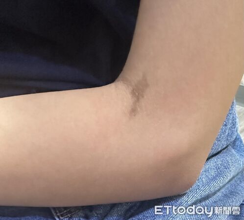 ▲女孩滿身「咖啡牛奶斑」醫一看皺眉！　示警2特徵恐藏遺傳病。（圖／黃紹基醫師授權提供，未經同意請勿任意翻攝）