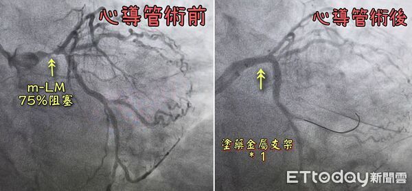 ▲▼胸悶冷汗飆2小時！他「寡婦血管塞75%」險死　醫揭5跡象快打119。(圖/曾國翔醫師授權提供，未經同意請勿任意翻攝)