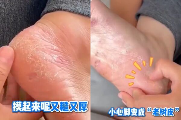 ▲▼夏天常穿「洞洞鞋」恐得角化型香港腳。（圖／翻攝自微博）