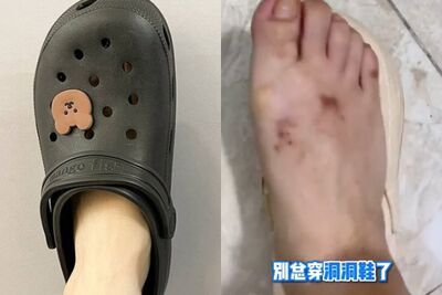 夏天常穿「洞洞鞋」恐得角化型香港腳　陸專家嘆：黴菌滋生溫床