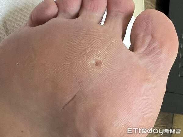 ▲▼每走一步痛飆淚！醫刮開驚見「雞眼怪物」：比前任更難甩。(圖／吳仁欽醫師授權提供，未經同意請勿任意翻攝)
