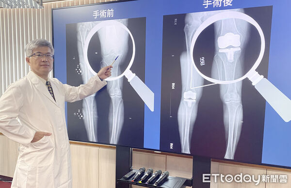 ▲台中榮總骨科部關節重建科主任曾崇育說明退化性膝關節炎治療新趨勢。（圖／記者游瓊華翻攝）