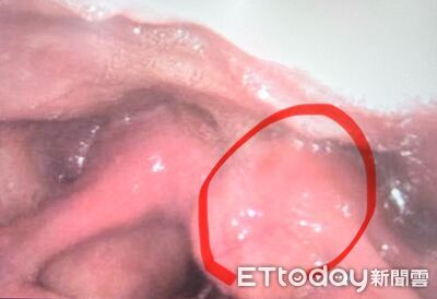 喉嚨卡1個月！不菸酒男「腫瘤幾乎封死」　醫嘆：再大恐窒息