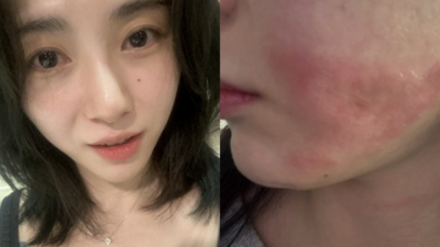 珉娥臉二度燒傷！院方惡劣擺爛　留嚴重疤痕：只剩看精神科的生活