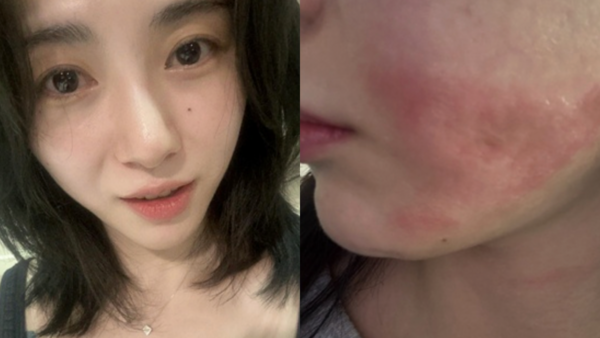 ▲▼權珉娥臉二度燒傷！院方惡劣擺爛　留嚴重疤痕：只剩看精神科的生活。（圖／翻攝自權珉娥IG）