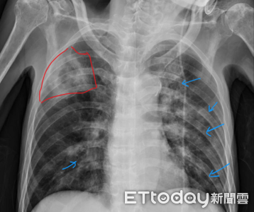 男久咳當感冒！醫X光驚見「肺被啃出空洞」急下令：立刻隔離
