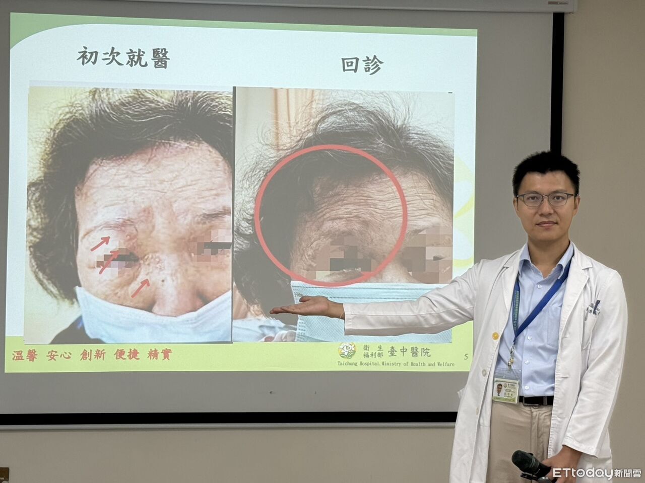 眼皮冒水皰以為過敏險失明!女遭「皮蛇」攻眼...醫曝好發4類人