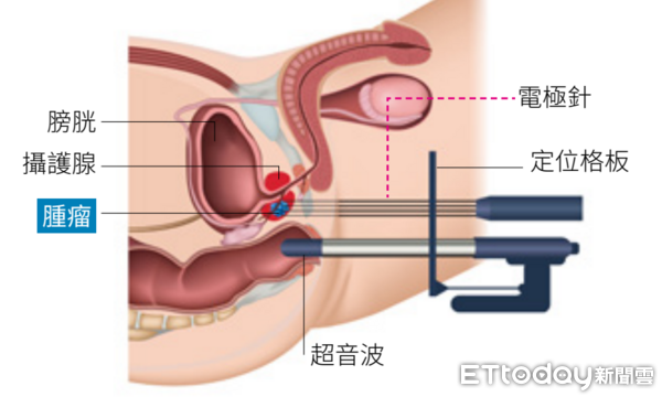 ▲▼       攝護腺癌      。（圖／北醫附醫提供）