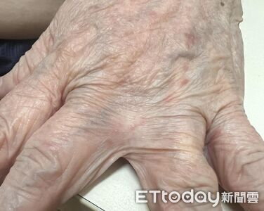 全身癢半年！醫驚見疥蟲「挖隧道產卵」　示警4大藏匿處